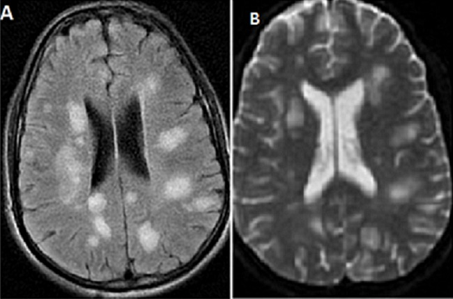 Typical MRI findings in #ADEM: A) Multifocal, bilateral, asymmetric white matter lesions on #FLAIR. B) Hyperintense lesions on #T2 sequences, consistent with CNS inflammation. 
Additional findings: Rare T1 hypointense lesions and deep grey matter involvement (e.g., thalamus or