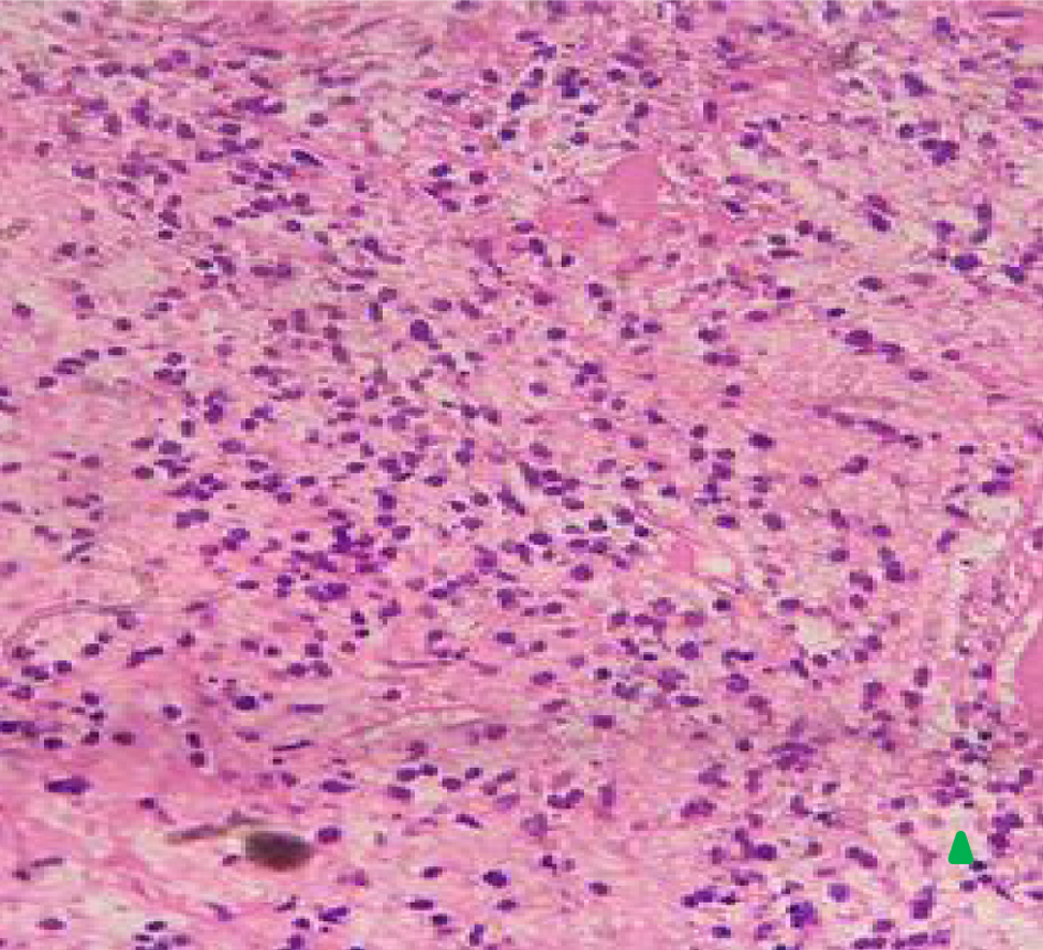 A Rare Case of #Leiomyosarcoma in a Fourteen-Year-Old Female: Challenges in Treatment and Recurrence Management
jcgo.org/index.php/jcgo…