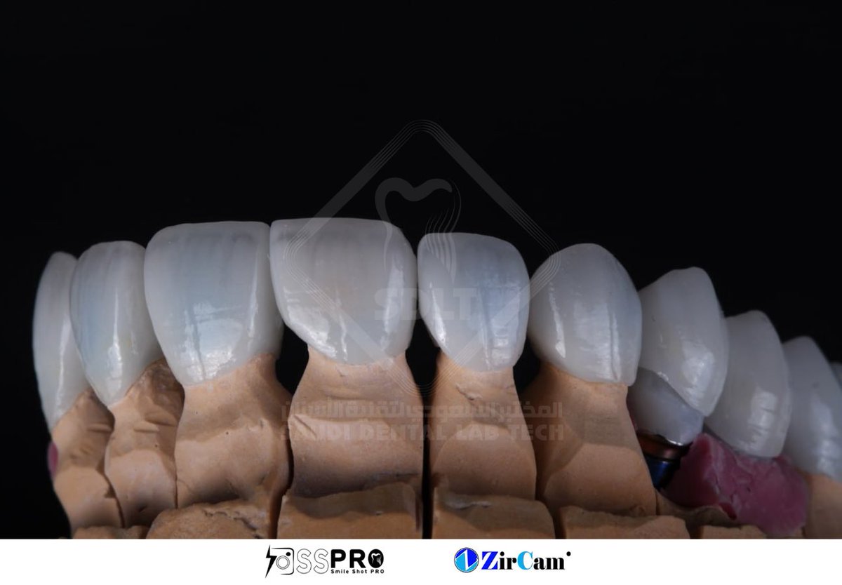 تركيبات أسنان تجمع بين التعويض فوق زراعة الأسنان وتصميمات الخزف الكامل المصنوعة من مادة الليثيوم دي سليكات 🖥️🌟👌🏼
.
#dental #معمل_اسنان #زراعة_الأسنان