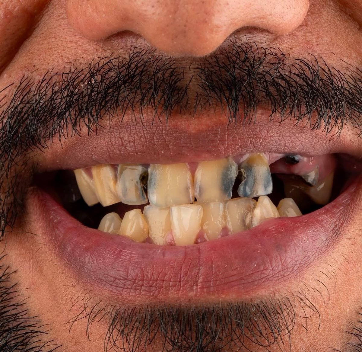 Dr_Adiccion's tweet photo. Cómo pueden hacer y vender este tipo de tratamientos y tapar el verdadero problema  de un paciente es una mentada de madre, espero que ninguno de mis colegas se atreva a hacer estos trabajos por solo sacarle dinero al paciente… espero que no sean dentistas🦷🚫🦷

Tantita madre. https://t.co/kVGmrv9LQ5