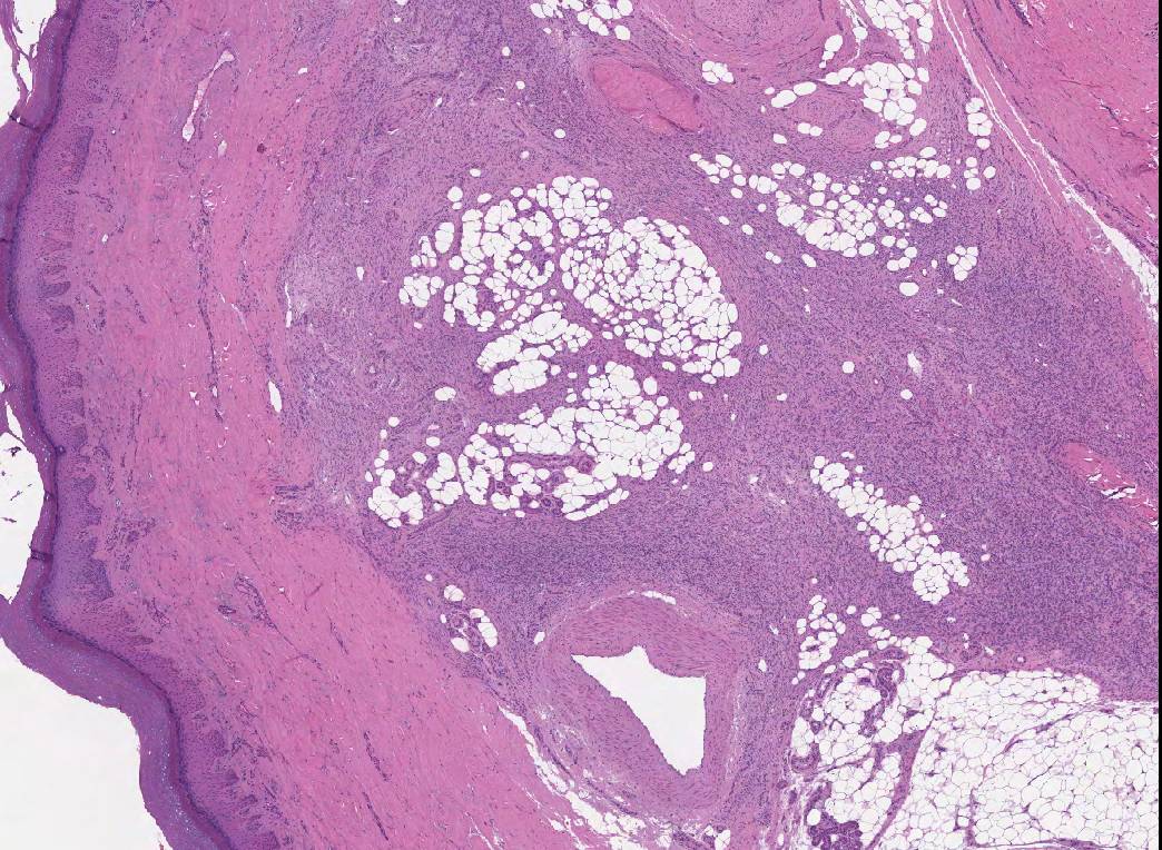 Left 4th toe amputation