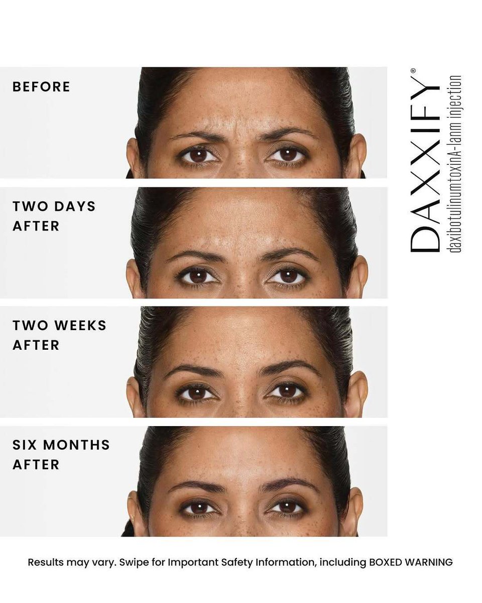 CWCMedSpa's tweet photo. DAXXIFY is the only long-lasting, peptide-powered frown line treatment. It works fast and the results are slow to wear off!

📞586-307-2109 to see if this is right for you! https://t.co/b1BFJZNqyX