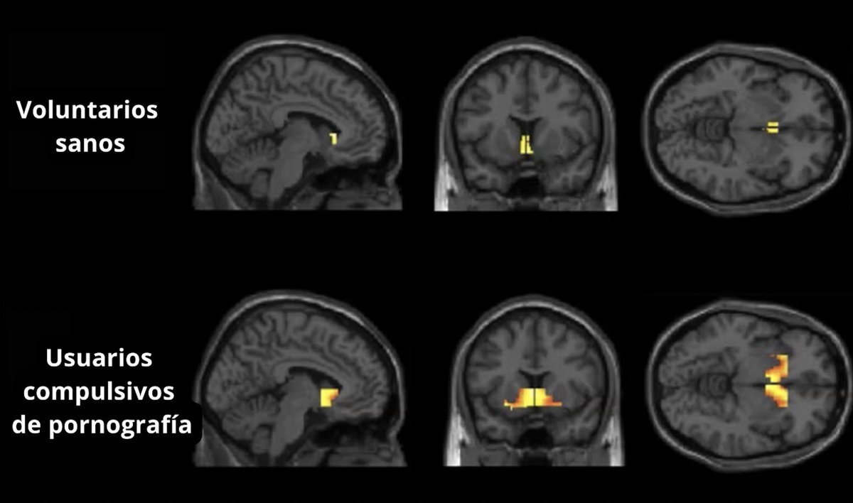 Antonio_RodriIA's tweet photo. Tengo 27 años.

Desperdicié 5 años de mi vida en P*rnhub todas las noches.

Después de más de 500 días sin p**n y más de 100 horas estudiando sus efectos en nuestro cerebro

Aquí están mis 5 descubrimientos más impactantes que cambiarán tu vida: https://t.co/0s1GUx8Dez