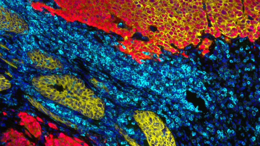 📰 NEWS: Hormone therapy-resistant #ProstateCancer could be treated with a new ICR-discovered drug, NXP800.

ICR scientists found that the drug, currently in trials for ovarian cancer, slowed the growth of prostate cancer cells in the lab.

Read more ⬇️
icr.ac.uk/about-us/icr-n…