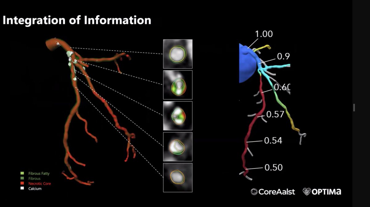 Ron Blankstein (@ronblankstein) on Twitter photo Amazing insights by <a href="/ColletCarlos/">Carlos Collet MD PhD</a> <a href="/BWHCVImaging/">Brigham and Women’s Cardiovascular Imaging Program</a> Grand Rounds on use of #CCTA to plan PCI. Guide Selection. Calcium distribution, morphology, and density. Prediction of flow / symptom improvement. And w/ #PCCT even more to come... Amazing insights by <a href="/ColletCarlos/">Carlos Collet MD PhD</a> <a href="/BWHCVImaging/">Brigham and Women’s Cardiovascular Imaging Program</a> Grand Rounds on use of #CCTA to plan PCI. Guide Selection. Calcium distribution, morphology, and density. Prediction of flow / symptom improvement. And w/ #PCCT even more to come...