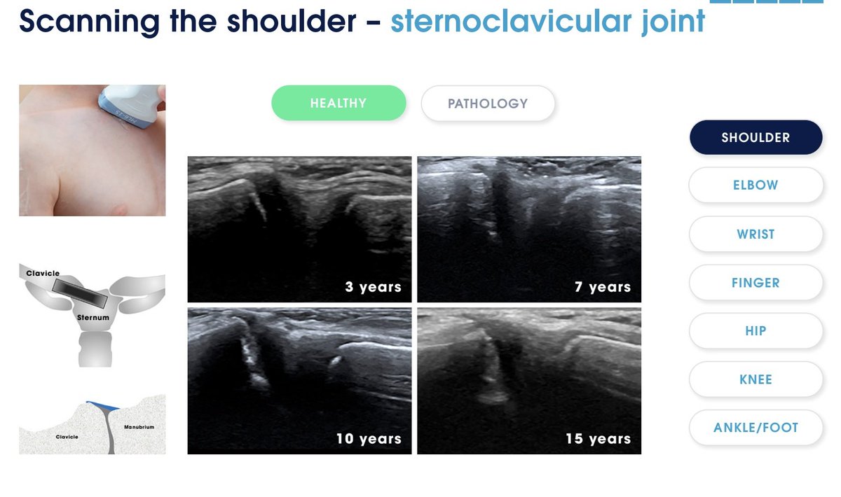 Rheumatology's tweet photo. FREE Pediatric Ultrasound Textbook to Download

https://t.co/iW3baM2imJ

The Ped-MUS e-book is also available to download in French, German, Portuguese, Turkish and Spanish.

Ped-MUS is a global educational initiative aiming to improve quality of care of pediatric rheumatology patients. Ped-MUS provides practical training tools and resources for pediatric rheumatologists who wish to incorporate the use of musculoskeletal ultrasonography into their clinical practice. 

The ultimate goal of Ped-MUS is to improve outcomes in pediatric rheumatology patients by enhancing diagnosis and ongoing assessment.