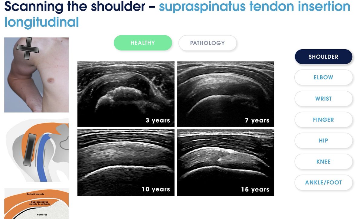 Rheumatology's tweet photo. FREE Pediatric Ultrasound Textbook to Download

https://t.co/iW3baM2imJ

The Ped-MUS e-book is also available to download in French, German, Portuguese, Turkish and Spanish.

Ped-MUS is a global educational initiative aiming to improve quality of care of pediatric rheumatology patients. Ped-MUS provides practical training tools and resources for pediatric rheumatologists who wish to incorporate the use of musculoskeletal ultrasonography into their clinical practice. 

The ultimate goal of Ped-MUS is to improve outcomes in pediatric rheumatology patients by enhancing diagnosis and ongoing assessment.