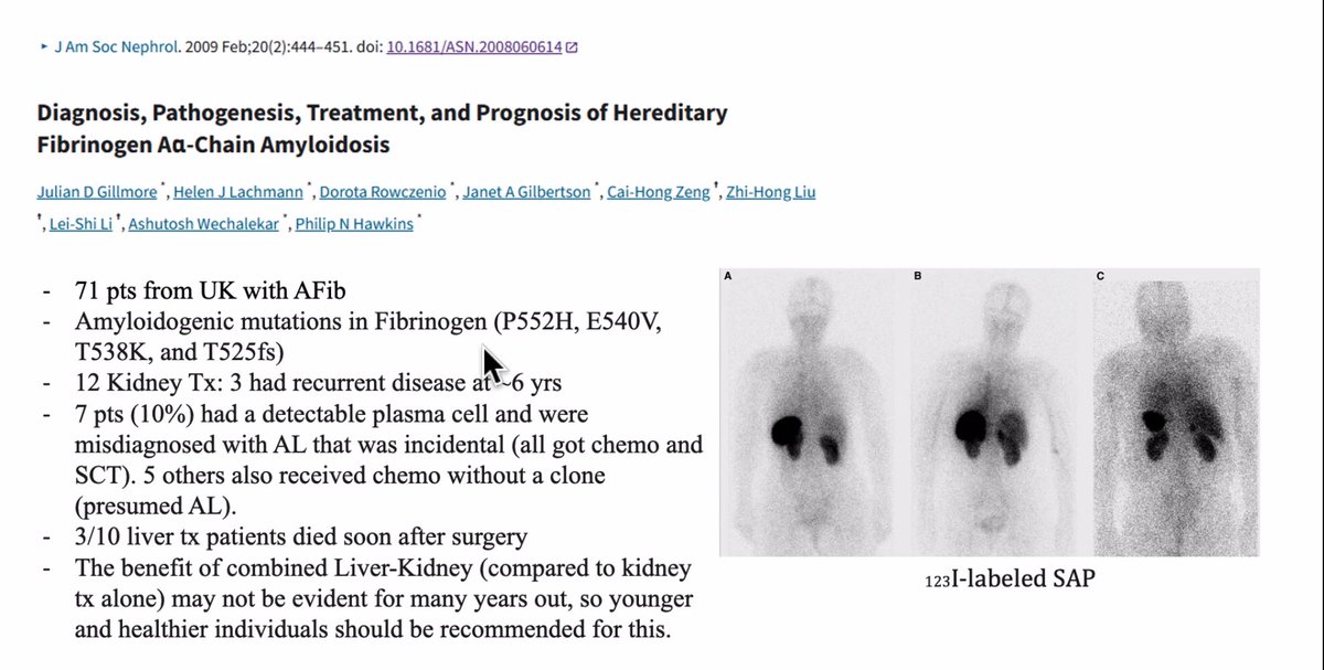 Izabela Zakrocka (@izabelazakrocka) on Twitter photo Great way to start 2025 with <a href="/Rush_Nephrology/">Rush Nephrology</a> ✨thanks for this exciting case! <a href="/Proximal_Baxi/">Pravir</a> <a href="/TWhittier_RUSH/">Bill Whittier</a> <a href="/NephRodby/">Roger Rodby</a> <a href="/BajinderR/">bajinder reen</a> Great way to start 2025 with <a href="/Rush_Nephrology/">Rush Nephrology</a> ✨thanks for this exciting case! <a href="/Proximal_Baxi/">Pravir</a> <a href="/TWhittier_RUSH/">Bill Whittier</a> <a href="/NephRodby/">Roger Rodby</a> <a href="/BajinderR/">bajinder reen</a>