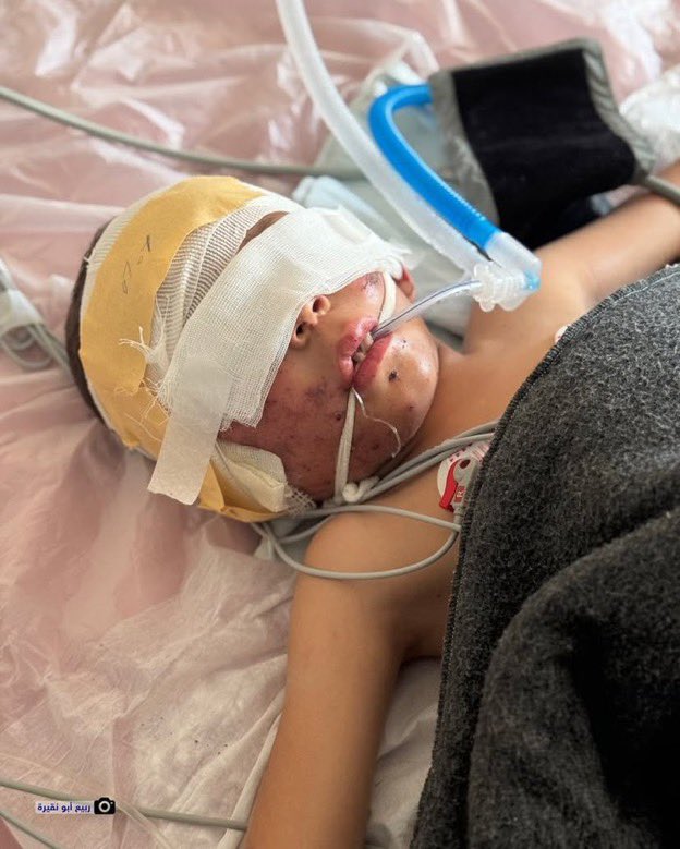 swilkinsonbc's tweet photo. Palestinian child Hussein Nagira is admitted to Nasser Hospital after he was critically injured by the israelis in a strike on tents in al-Mawasi, Gaza https://t.co/jRDuRQMiW5