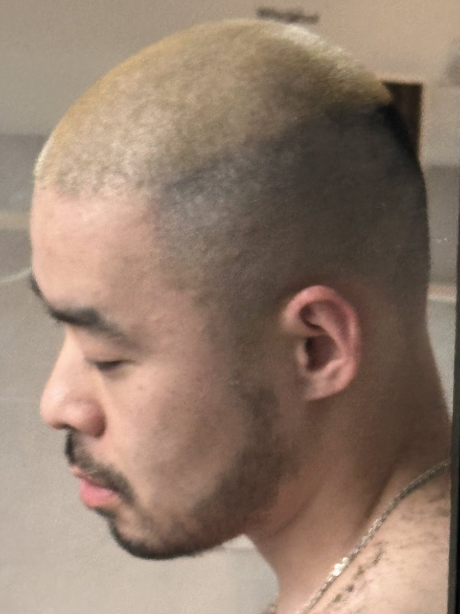 成都—脱毛店🪒 店v：nstm323

​美团 大众搜 “三二三男士脱毛店”