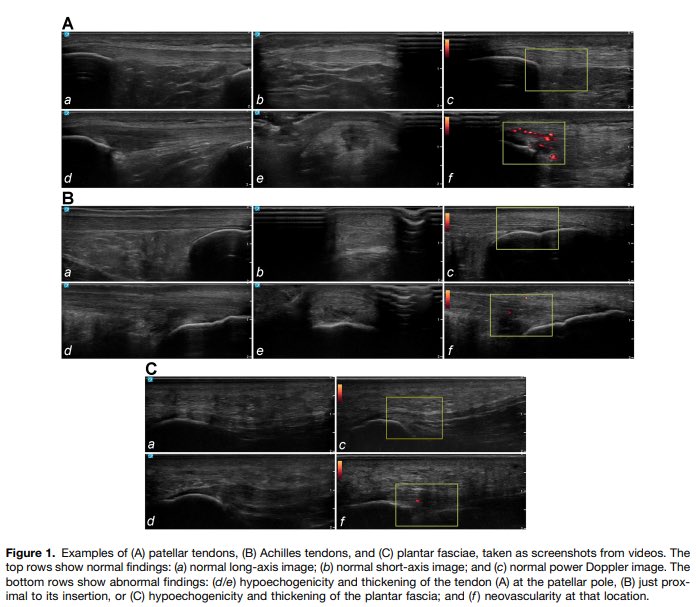🧵1/ 

👉 pmc.ncbi.nlm.nih.gov/articles/PMC11… 

Research on using ultrasound screening to predict tendon injuries in NCAA athletes. A study by Cushman et al. followed 242 D1 athletes for a full year, examining patellar tendon, Achilles tendon, and plantar fascia. Here's what they found...