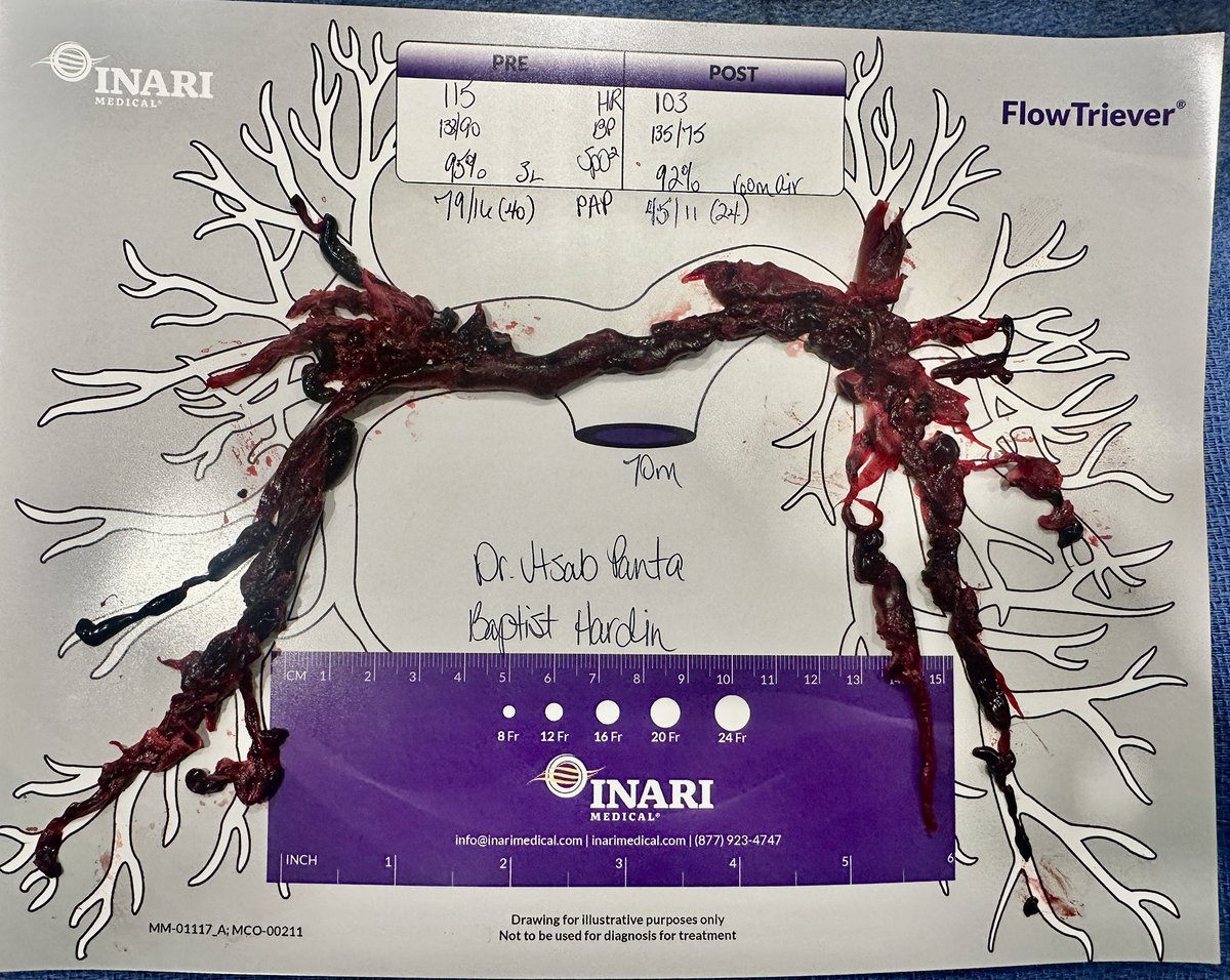#Juicyclots #INARI #pulmonaryembolism 
Pulmonary aspiration thrombectomy