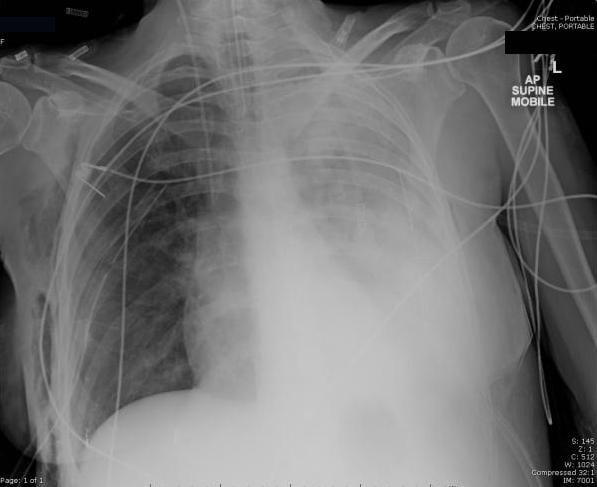 LITFL (@litflblog) on Twitter photo Metastatic ovarian cancer treatment takes a sudden turn post-VATS pleurodesis, leading to ICU care. A testament to the unpredictable path of oncology treatment and the steadfast dedication to patient recovery. #MedTwitter #MedEd #FOAMed  litfl.com/pulmonary-re-e… Metastatic ovarian cancer treatment takes a sudden turn post-VATS pleurodesis, leading to ICU care. A testament to the unpredictable path of oncology treatment and the steadfast dedication to patient recovery. #MedTwitter #MedEd #FOAMed  litfl.com/pulmonary-re-e…