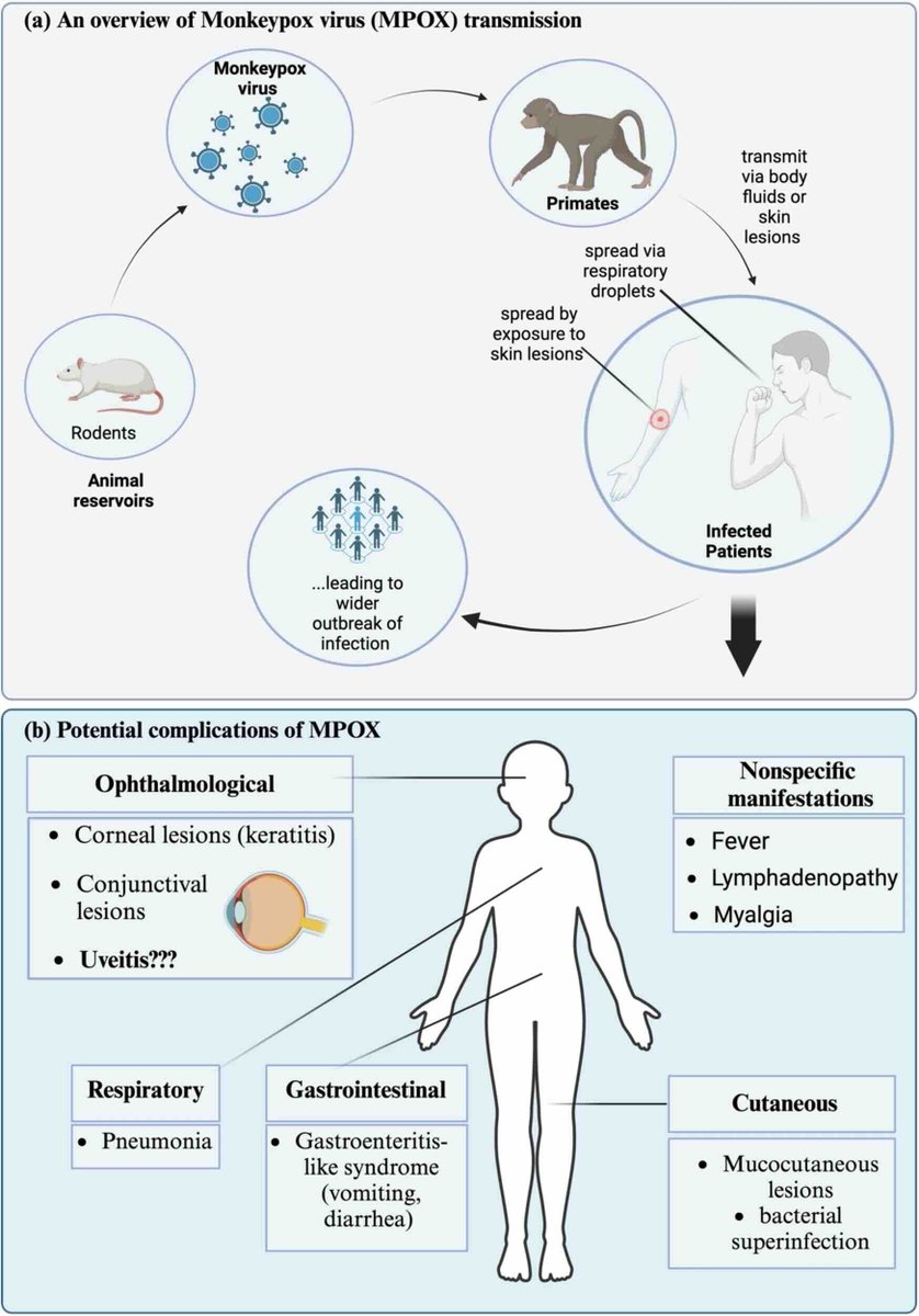 Eye_Journal's tweet image. EDITORIAL: The global #monkeypox outbreak raises urgent concerns about overlooked complications, including ophthalmological issues. Studies highlight a 2x higher risk of uveitis in monkeypox patients. Read more here: nature.com/articles/s4143… 
#Ophthalmology