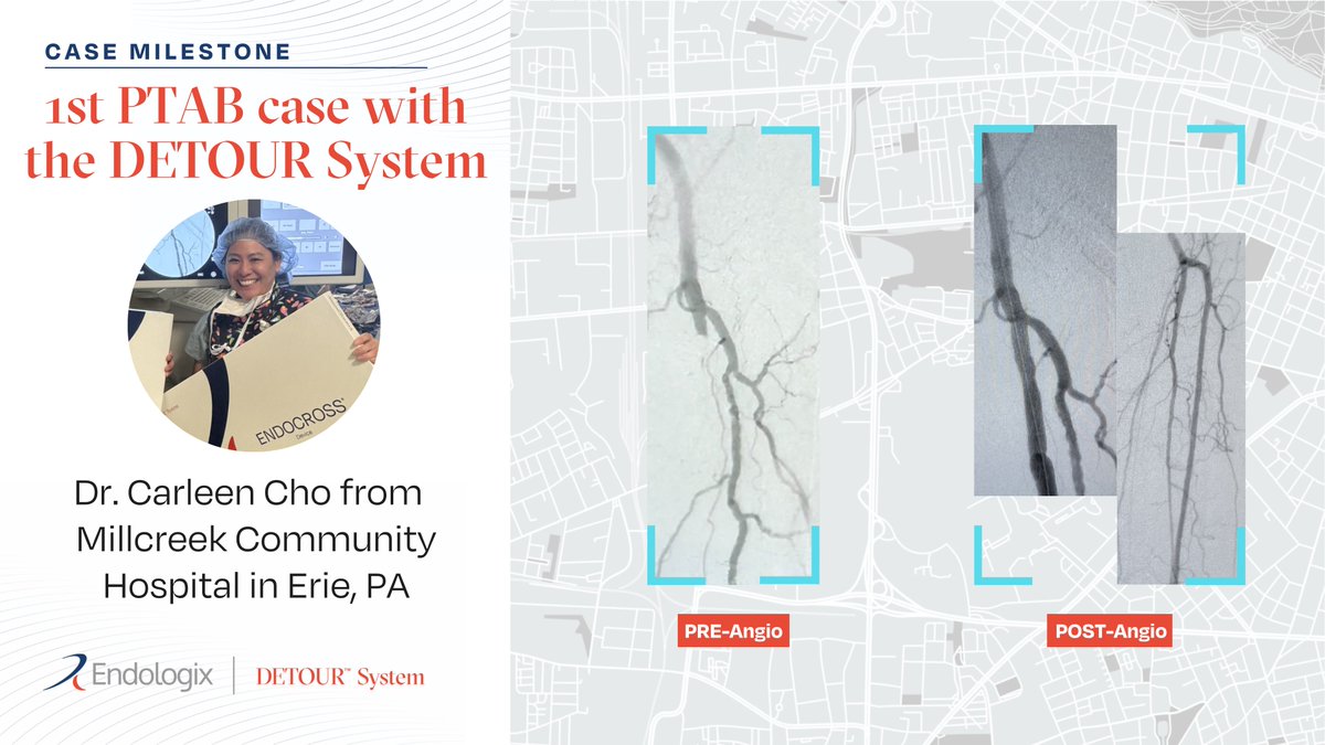 endologix's tweet photo. 80-year-old female patient presented with 37 cm long-segment SFA.
Congratulations to Dr. Carleen Cho from Millcreek Community Hospital in Erie, PA on her first PTAB case with the DETOUR System. 
Learn more about the DETOUR System here
https://t.co/rJayGgmZ48
#PAD #PTAB https://t.co/qpEd8PLNj0
