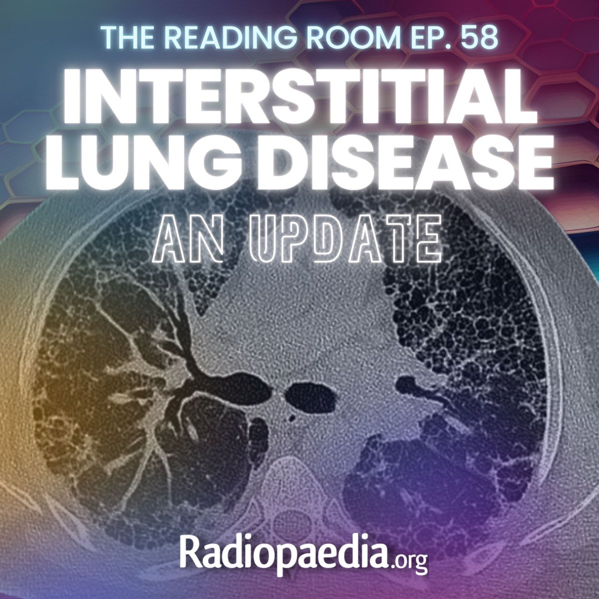 Andrew Dixon (@drandrewdixon) on Twitter photo New podcast ep! Miranda Siemienowicz chats with <a href="/jonherochung/">Jonathan Chung, MD</a> and Jeffrey Kanne about HRCT and ILD.
Apple: podcasts.apple.com/us/podcast/the…
Spotify: open.spotify.com/show/6iQe9v7Tc…
YouTube: youtube.com/playlist?list=…
🎧 radiopaedia.org/podcast #chestrad New podcast ep! Miranda Siemienowicz chats with <a href="/jonherochung/">Jonathan Chung, MD</a> and Jeffrey Kanne about HRCT and ILD.
Apple: podcasts.apple.com/us/podcast/the…
Spotify: open.spotify.com/show/6iQe9v7Tc…
YouTube: youtube.com/playlist?list=…
🎧 radiopaedia.org/podcast #chestrad