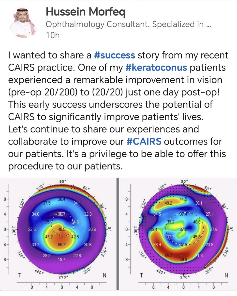 One of my #keratoconus patients experienced a remarkable improvement in vision (pre-op 20/200) to (20/20) just one day after #CAIRS implantation! This early success underscores the potential of CAIRS to significantly improve patients' lives.