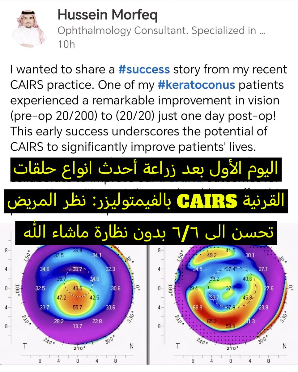 تطور العلم وأصبحت حلقات القرنية عبارة عن نسيج حلقي طبيعي (كيرز-CAIRS) بدلاً من الحلقات البلاستيكية. هذا يمنح تحسن أكبر وأسرع في النظر و أمان أعلى ونسبة مضاعفات أقل. مثال أحد مرضاي في العيادة👇🏻
#cairs #keratoconus #زراعة_قرنية #زراعة_حلقات #قرنية_مخروطية #دكتور_عيون #جدة