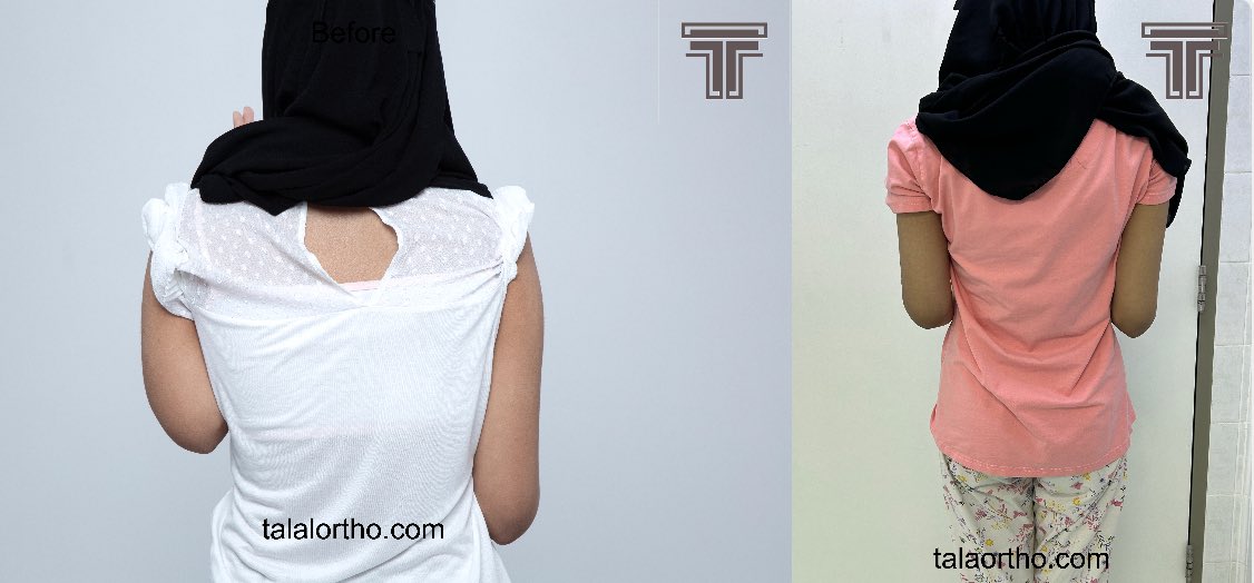 تعرض المريض لتوقف لمركز النمو في عظمة الذراع اثناء السنين الأولى من العمر وأدى ال ٦ سم فرق طول.

و بواسطة عمليات #تطويل_العظام من الممكن تطويل عظمة الذراع. نستخدم هنا مثبت خارجي للتطويل التدريجي.
 
 للتفاصيل: 
talalortho.com/before_and_aft…