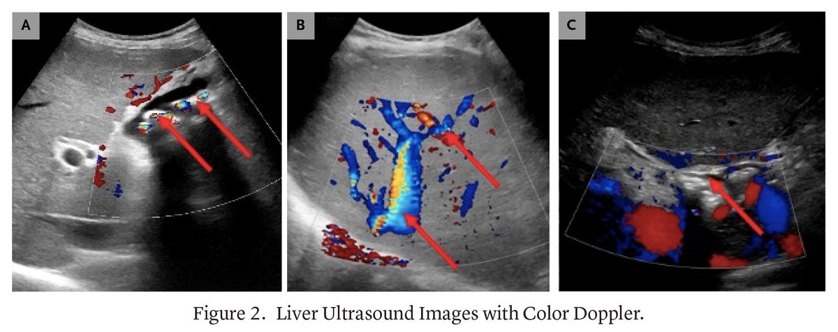 NEJMEvidence's tweet photo. A 52-year-old man with sickle cell disease presented for evaluation of subacute abdominal pain and jaundice. A team from @CookCountyIMR reviews their approach to evaluating this patient. https://t.co/C84HMiZCbx

@KirtanPatolia #MedEd https://t.co/aPSMG7dnTT