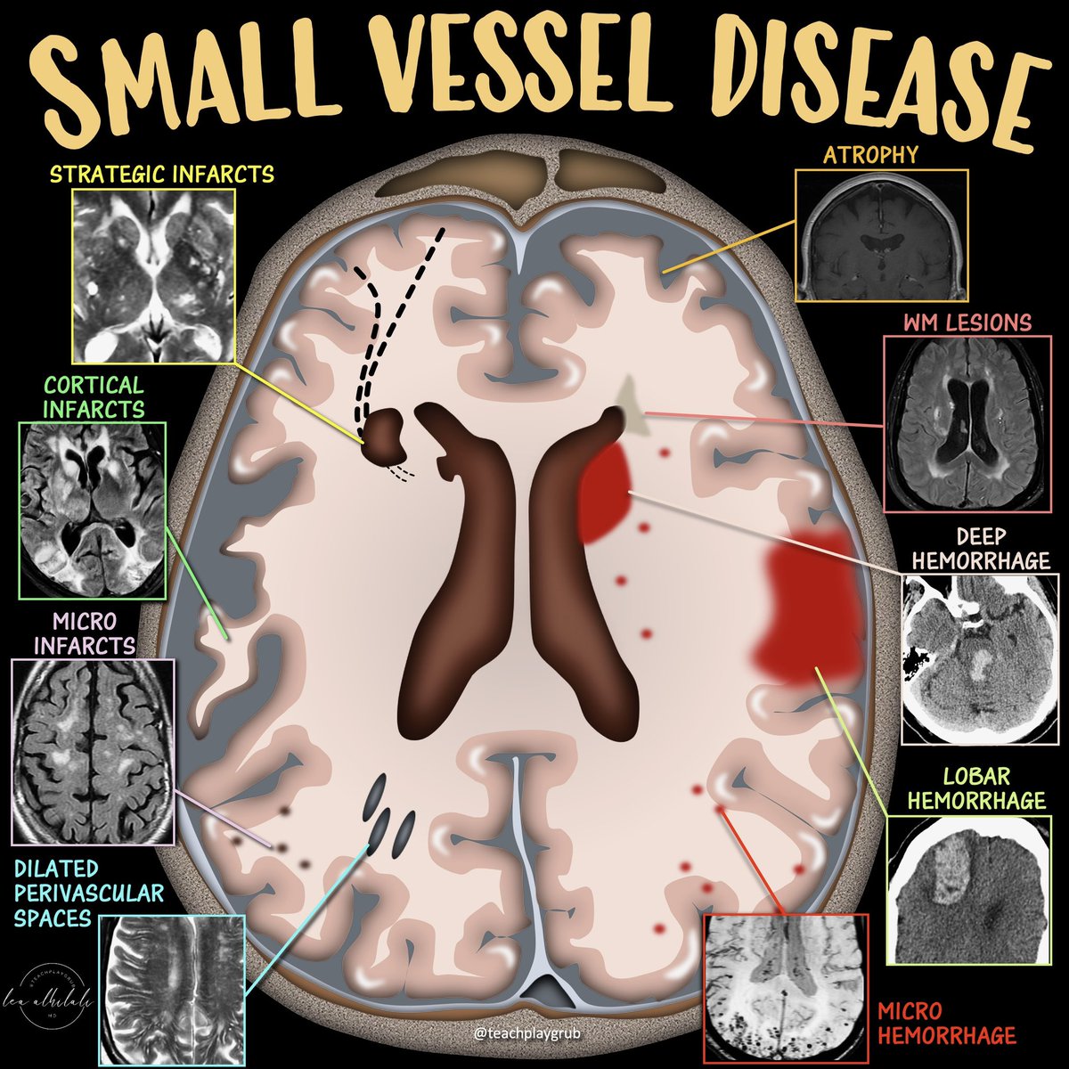 Lea Alhilali, MD tweet media