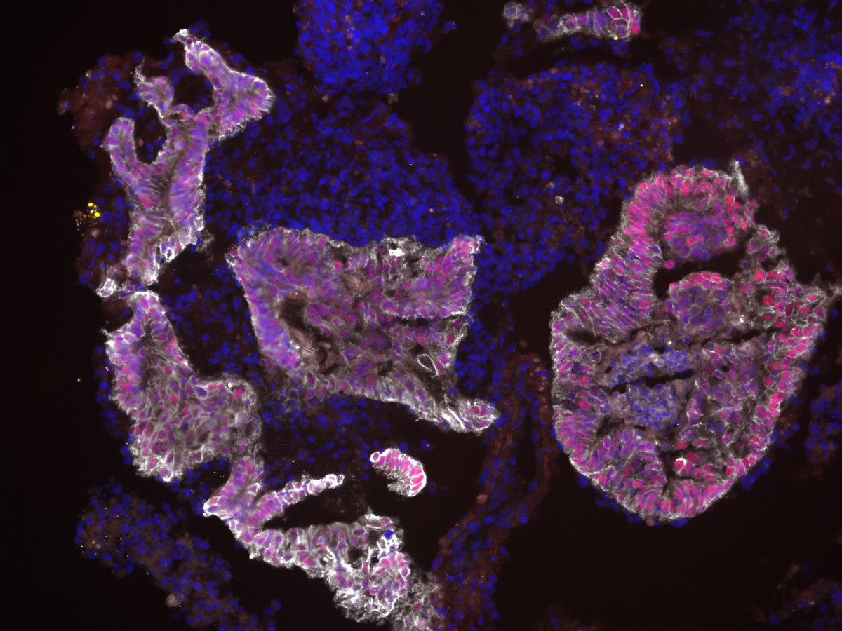 human pluripotent stem cell derived colonic organoid stained for E-CAD (white) CLDN1 (green but not detectable) and CDX2 (red). #FluorescenceFriday #sciart #bioart #organoids
