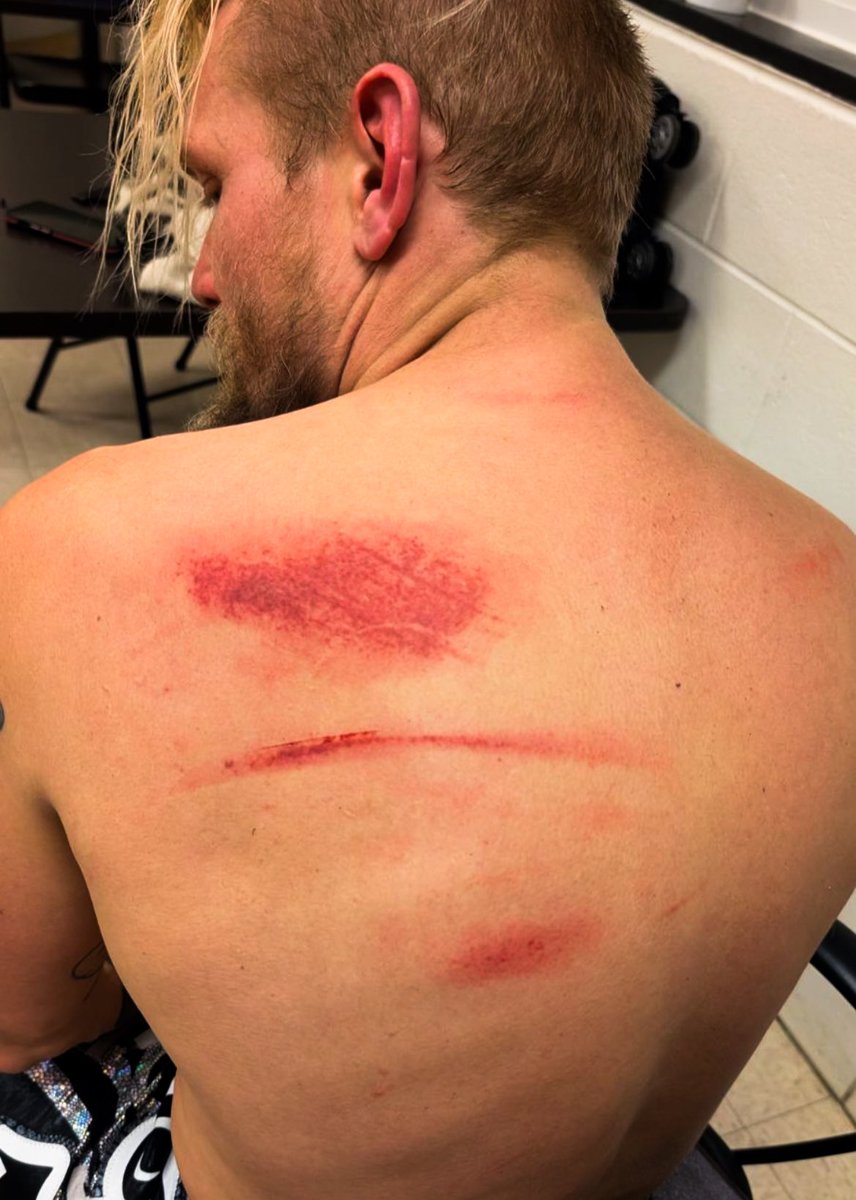PWRevolver's tweet photo. Jake Crist’s battle scars from his instant classic against Masato Tanaka!

#RevolverVYBE 

Watch the @FiteTV+ replay, NOW: https://t.co/WlVfZCQwSB https://t.co/denYmHqTqm