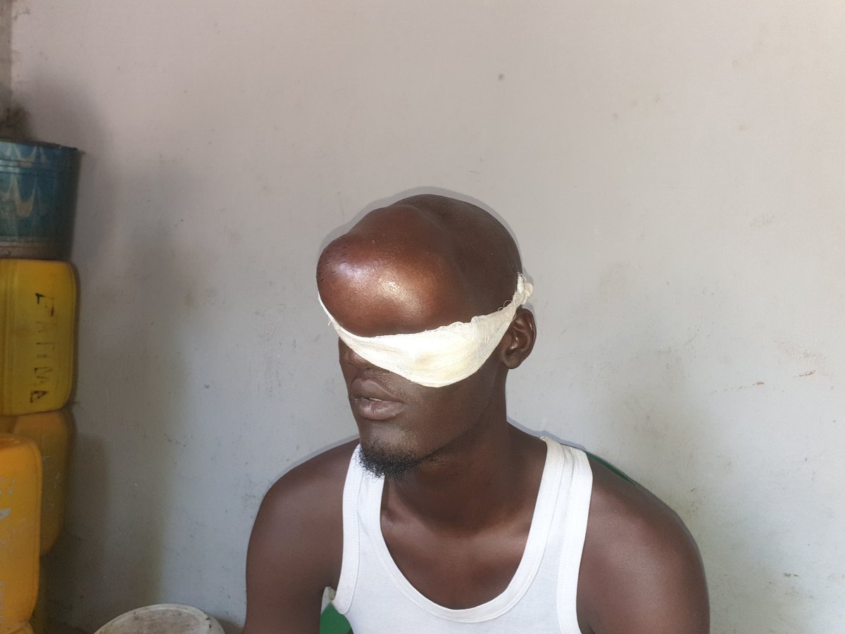 Guineematin's tweet photo. 🆘️ SOS pour Bella Oury Bah souffrant d'une tumeur de l'œil gauche. 

C'est un chauffeur de camion. Depuis plus de 2 ans, Bella Oury souffre de cette tumeur qui risque de l'emporter si rien n'est fait. Il réside à Yattaya T6. 

[1/2] https://t.co/kfOP564eUx