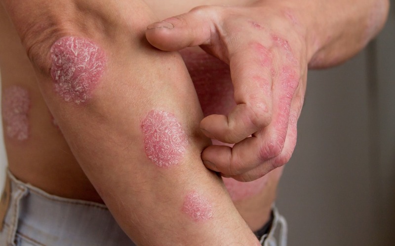 #Salud | ¿Qué es la psoriasis nerviosa y cómo identificarla?

Amplía la información aquí: noticiasvenevision.com/noticias/salud…

#NoticiasVenevision #30Dic