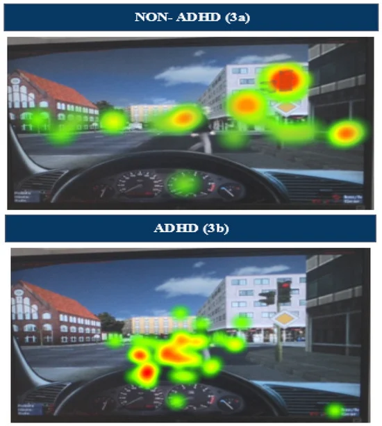 Sensors_MDPI's tweet image. Reducing Driving Risk Factors in Adolescents with Attention Deficit Hyperactivity Disorder (ADHD): Insights from #EEG and #EyeTracking Analysis
mdpi.com/1424-8220/24/1…
#ADHD #driving