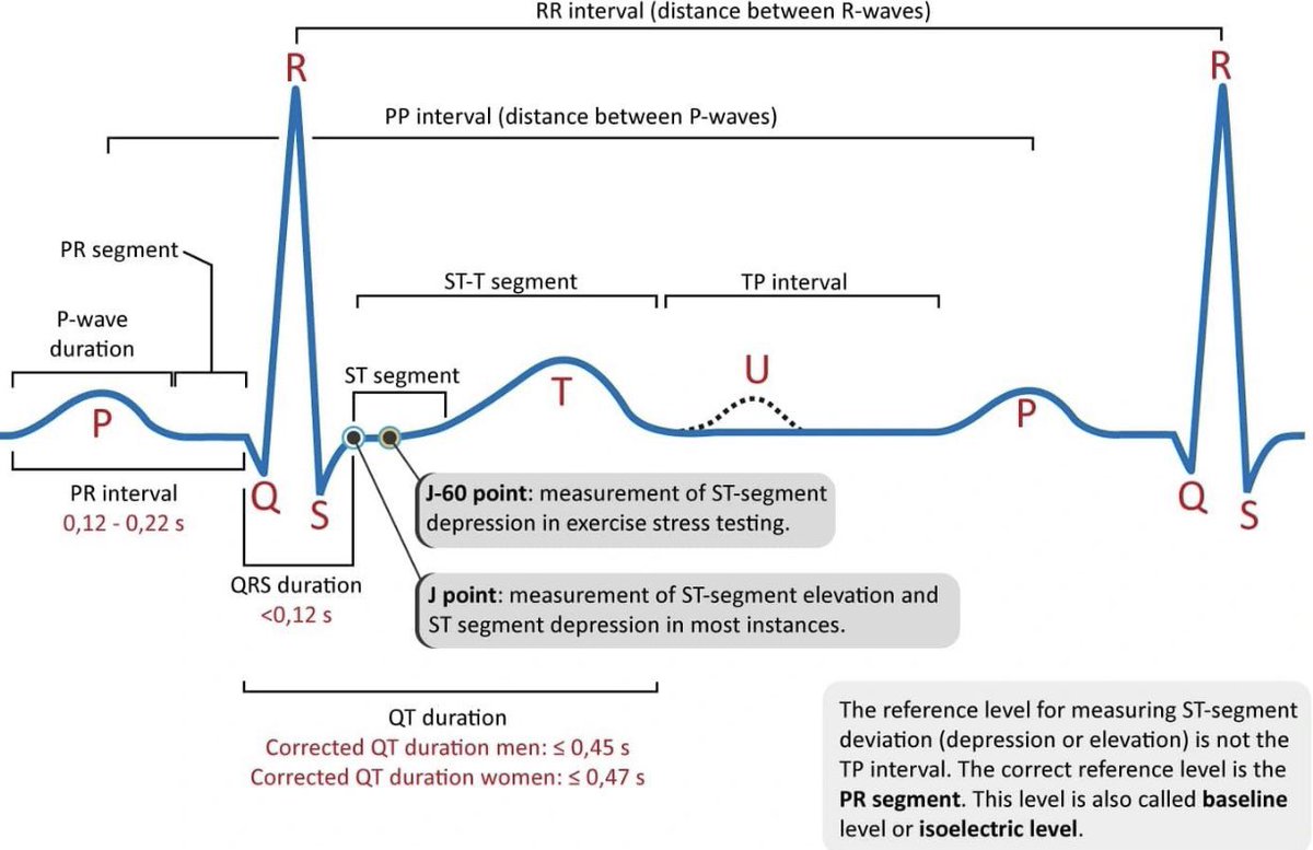 ECG interpretation

#meded #medx #Science #ECG #CardioTwitter #Cardiology