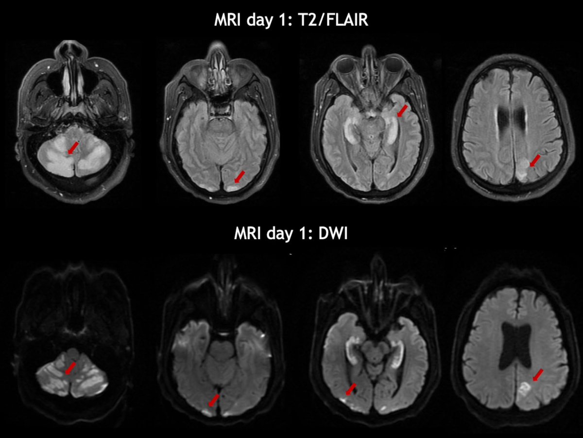 Marinos Sotiropoulos, MD 🇬🇷🧠 (@marinos_s) on Twitter photo New publication: CHANTER is an under-recognized syndrome of multifocal cerebral edema after opioid ingestion. It's important to recognize: diffusion restriction and edema are reversible and outcomes are promising!
Free copy: tinyurl.com/2s468pz4
<a href="/DanHarrisonMD/">Dan Harrison, MD</a> <a href="/BWHNeuroICU/">Brigham and Women’s Neurocritical Care</a> New publication: CHANTER is an under-recognized syndrome of multifocal cerebral edema after opioid ingestion. It's important to recognize: diffusion restriction and edema are reversible and outcomes are promising!
Free copy: tinyurl.com/2s468pz4
<a href="/DanHarrisonMD/">Dan Harrison, MD</a> <a href="/BWHNeuroICU/">Brigham and Women’s Neurocritical Care</a>