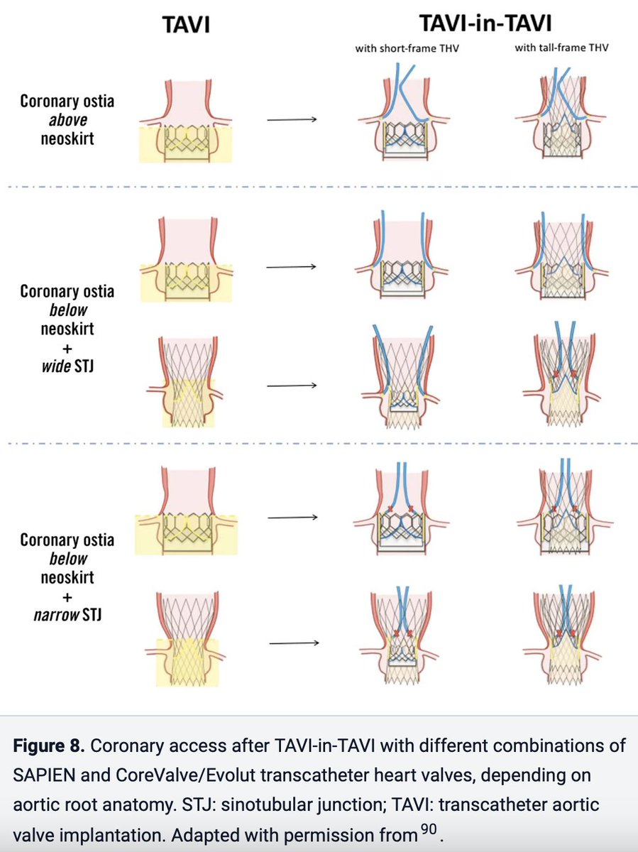 EuroIntervention (@eurointerventio) on Twitter photo Managing CAD in TAVI patients is critical as #TAVI expands to younger, lower-risk populations. A new consensus highlights strategies for CAD evaluation, PCI timing, and preserving coronary access for optimal outcomes. <a href="/G_Tarantini01/">Giuseppe_Tarantini</a> #EIJBestOf
ow.ly/W1Cq50UxS9r Managing CAD in TAVI patients is critical as #TAVI expands to younger, lower-risk populations. A new consensus highlights strategies for CAD evaluation, PCI timing, and preserving coronary access for optimal outcomes. <a href="/G_Tarantini01/">Giuseppe_Tarantini</a> #EIJBestOf
ow.ly/W1Cq50UxS9r