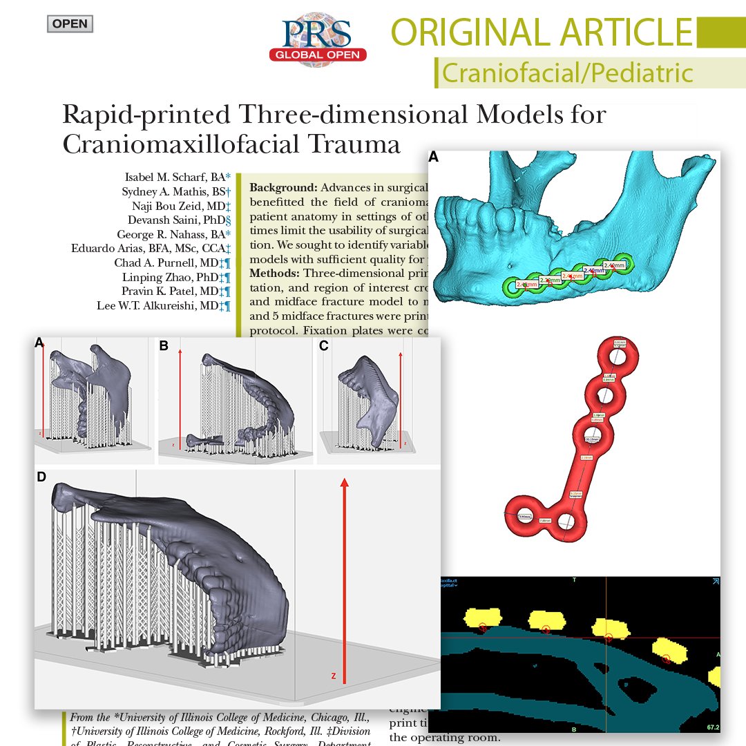 How can the #3DPrinting process be optimized to reduce print time and maintain clinical accuracy in urgent craniomaxillofacial trauma surgery? Read, "Rapid-printed Three-dimensional Models for #CraniomaxillofacialTrauma," to find out:
l8r.it/UdXC
