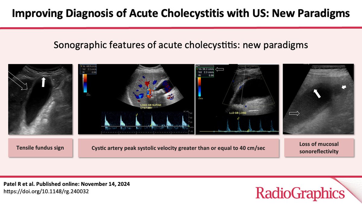 RadioGraphics (@radiographics) on Twitter photo Questioning acute cholecystitis? Don’t over-rely on the sonographic Murphy sign! Discover how nuanced and predictive findings can improve your diagnostic accuracy. 👉 bit.ly/3DaGGMH <a href="/RichaPatelMD/">Richa Patel</a> <a href="/ayakamaya/">Aya Kamaya, MD</a> <a href="/JustinTseMDRad/">JustinTseMDRadiology</a> <a href="/Luyaoshenmd/">Luyao Shen, MD</a> <a href="/StanfordBodyRad/">Stanford Body Imaging</a> <a href="/StanfordRad/">Stanford Radiology</a> Questioning acute cholecystitis? Don’t over-rely on the sonographic Murphy sign! Discover how nuanced and predictive findings can improve your diagnostic accuracy. 👉 bit.ly/3DaGGMH <a href="/RichaPatelMD/">Richa Patel</a> <a href="/ayakamaya/">Aya Kamaya, MD</a> <a href="/JustinTseMDRad/">JustinTseMDRadiology</a> <a href="/Luyaoshenmd/">Luyao Shen, MD</a> <a href="/StanfordBodyRad/">Stanford Body Imaging</a> <a href="/StanfordRad/">Stanford Radiology</a>