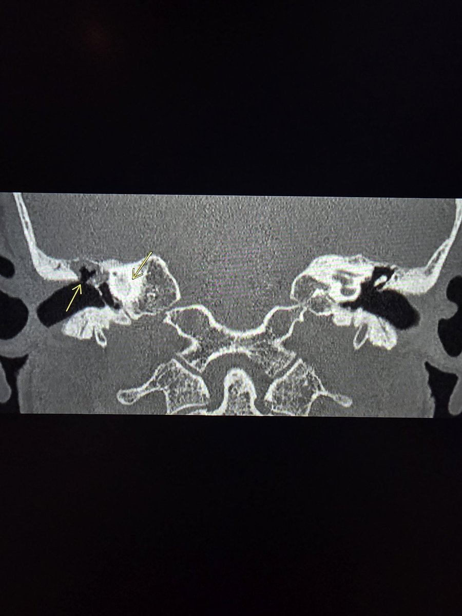 HugoTames's tweet photo. Last case of the year - auto-atticotomy with mural cholesteatoma and labyrinthitis ossificans https://t.co/A9B0rMq8OF