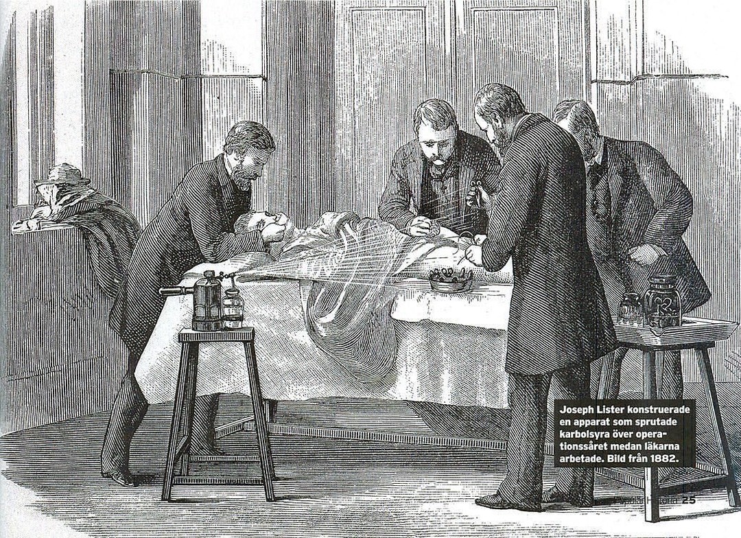 Joseph Lister, pioneer of antiseptic surgery, spraying phenol over a patient. #histmed #histsurg #historyofmedicine #historyofsurgery #pastmedicalhistory