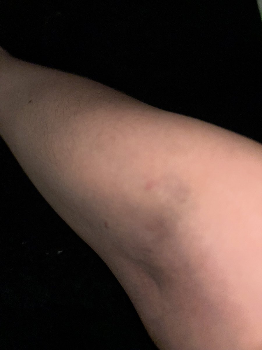 I had my full panel of bloods taken at hospital before I commit to a drug. I had a big story about how they struggle to get blood etc. when I saw all the vials I thought that’s not happening. Small needle, 1st attempt not even a bruise. Amazing 🤩