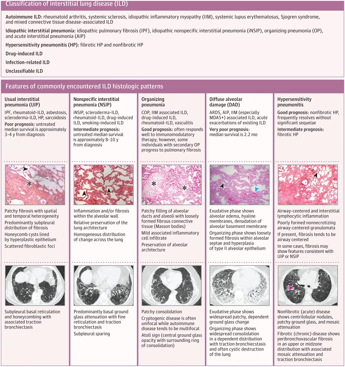 JAMA (@jama_current) on Twitter photo <a href="/LRSorce/">Lauren R. Sorce</a> <a href="/SebastianPalmqv/">Sebastian Palmqvist</a> <a href="/NiklasMattsson4/">Niklas Mattsson-Carlgren</a> <a href="/criticcaredoc/">Jan De Waele MD</a> Most Viewed JAMA 2024: Interstitial Lung Disease
🔗 ja.ma/49HAZ52
<a href="/TobyMMaher/">Toby Maher</a> <a href="/LRSorce/">Lauren R. Sorce</a> <a href="/SebastianPalmqv/">Sebastian Palmqvist</a> <a href="/NiklasMattsson4/">Niklas Mattsson-Carlgren</a> <a href="/criticcaredoc/">Jan De Waele MD</a> Most Viewed JAMA 2024: Interstitial Lung Disease
🔗 ja.ma/49HAZ52
<a href="/TobyMMaher/">Toby Maher</a>