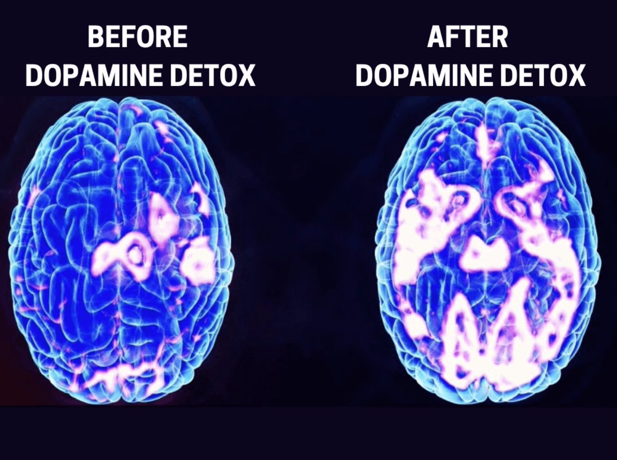 Dopamine is the modern-day devil.

It is the root cause of:

- depression
- addiction
- anxiety

Here's the protocol for getting "Dopamine Detox" in 2025.

(🧵)