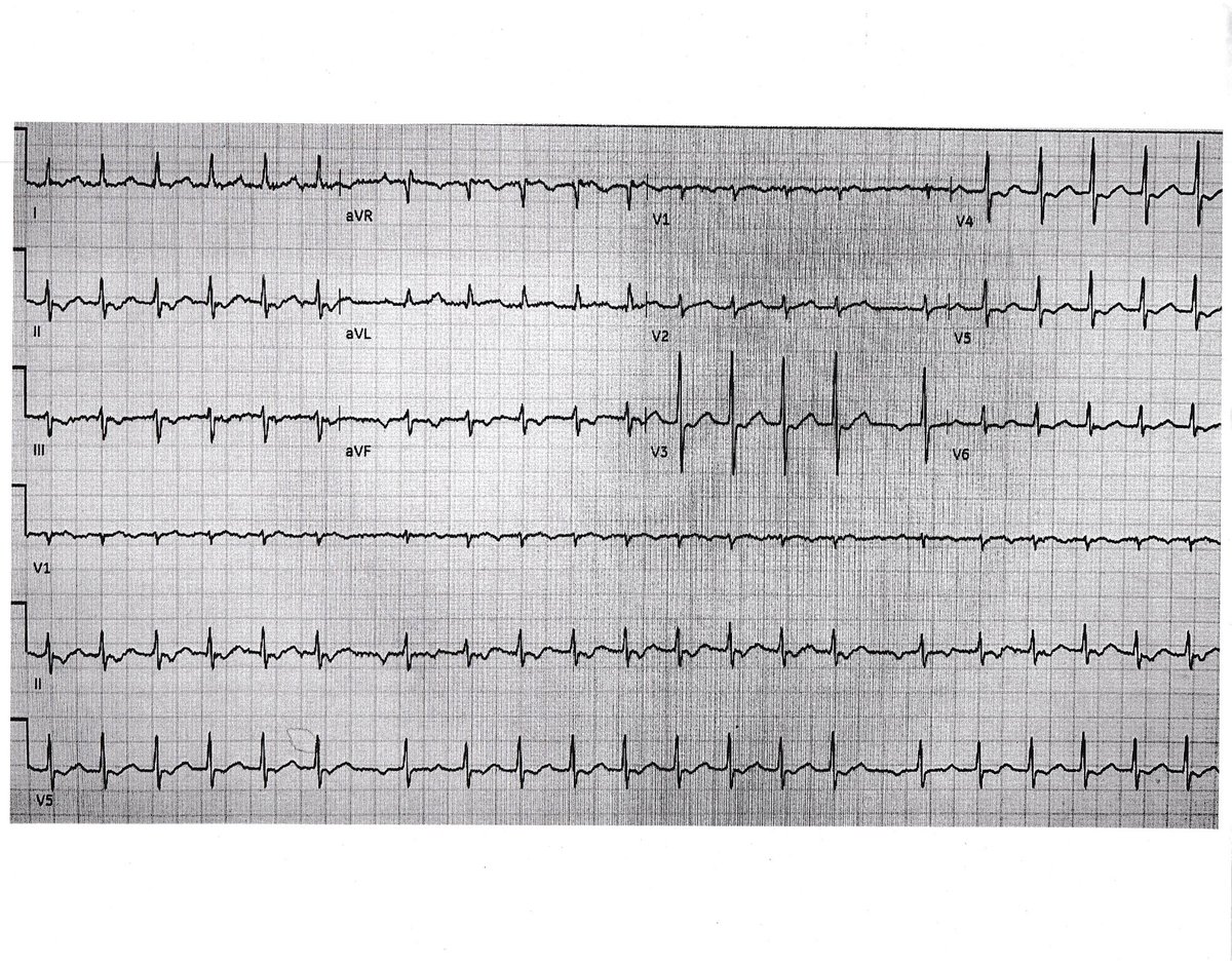 ECG for the week and to begin the New Year. 36 year old woman with history of palpitations but no underling heart disease. What is the diagnosis? #PodridECGs #ECG #meded #cardiotwitter