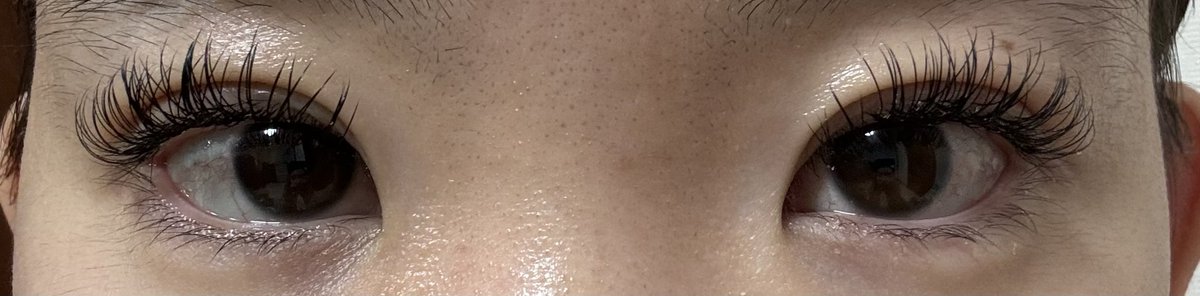 J1jy1091c's tweet photo. 記録用
水の森埋没DT3日目👁️👁️
ほぼ腫れなくなった！
傷跡あり内出血なし
白いポチってしたものまだある https://t.co/nw7dzsERWb
