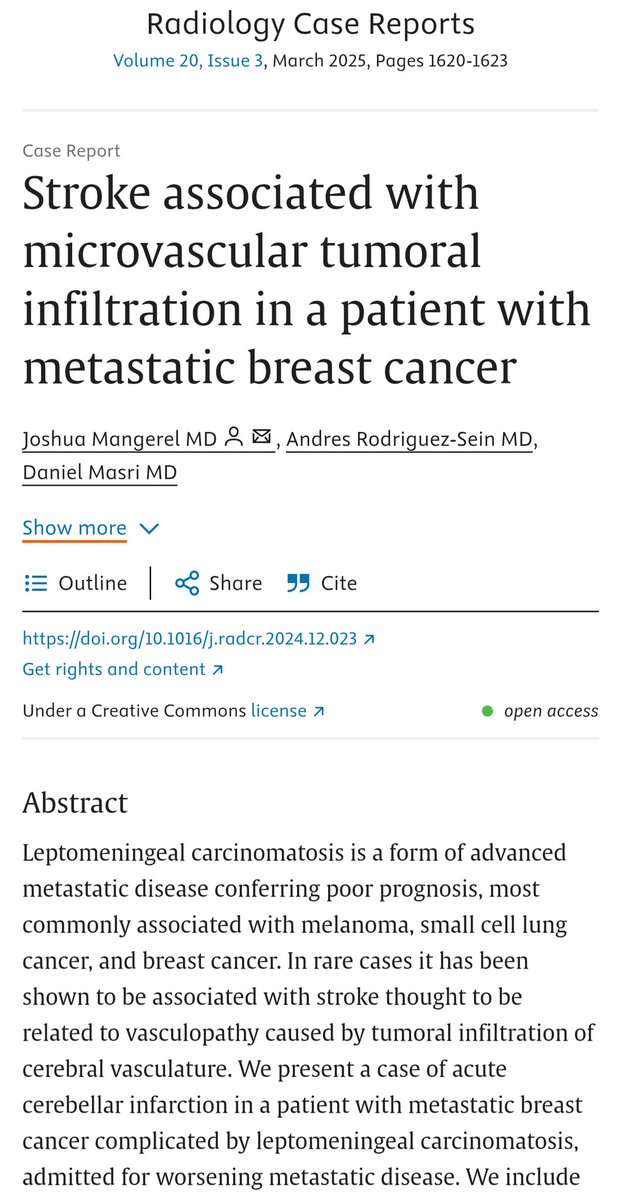 Stroke associated with microvascular tumoral infiltration in a patient with metastatic breast cancer

sciencedirect.com/science/articl…

<a href="/danmasri/">Danny Masri</a>