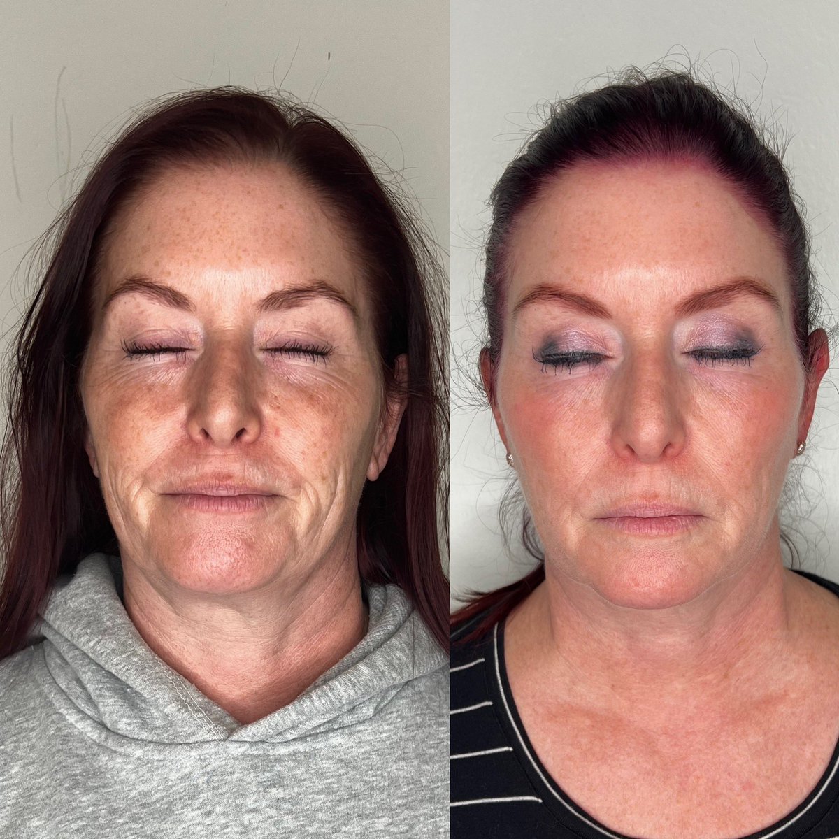 ElementEsthetic's tweet image. IPL plus Vivace RF Microneedling plus Exosomes. 3 weeks after.