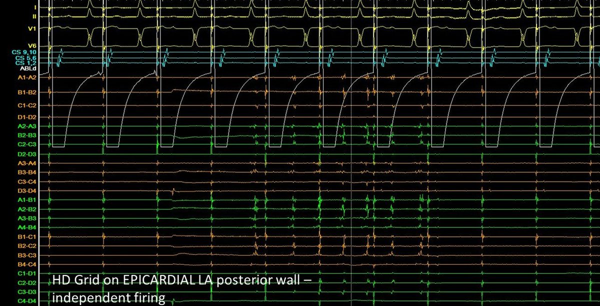 Dr Vishal Luther (@vish_luther) on Twitter photo #EPeeps - we don't see this too often - independent endo & epicardial firing captured on HD Grid <a href="/AbbottCardio/">Abbott Cardiovascular</a> following left atrial posterior wall isolation <a href="/LiverpoolEP/">Liverpool Heart Rhythm</a> #EPeeps - we don't see this too often - independent endo & epicardial firing captured on HD Grid <a href="/AbbottCardio/">Abbott Cardiovascular</a> following left atrial posterior wall isolation <a href="/LiverpoolEP/">Liverpool Heart Rhythm</a>