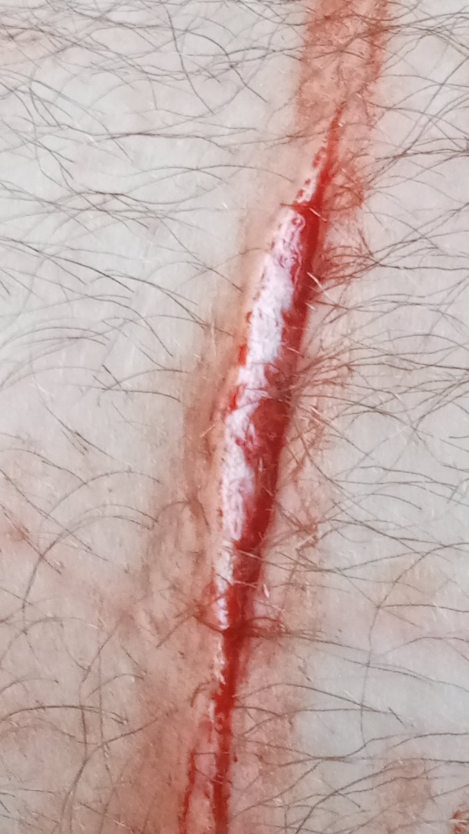 ReeceElmes's tweet photo. New years eve... Here we go again.
I feel shit that it isn't deep😣😖 https://t.co/vgo3YQR0Mx