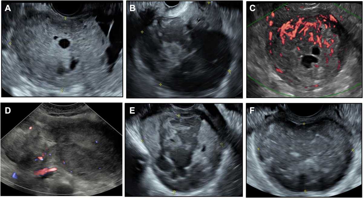 A clinical ultrasound algorithm to identify uterine sarcoma and smooth muscle tumors of uncertain malignant potential in patients with myometrial lesions: the MYometrial Lesion UltrasouNd And mRi study ajog.org/article/S0002-…