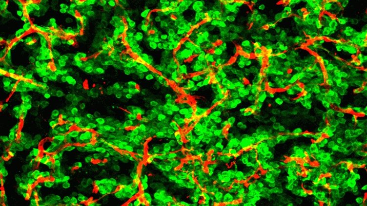 A new ‘molecular lantern’ detects brain metastasis in mice by inserting a probe thinner than a hair into the brain.
It provides information on the chemical composition of brain tissue, enabling the study of molecular changes caused by tumors or traumatisms
eurekalert.org/news-releases/…