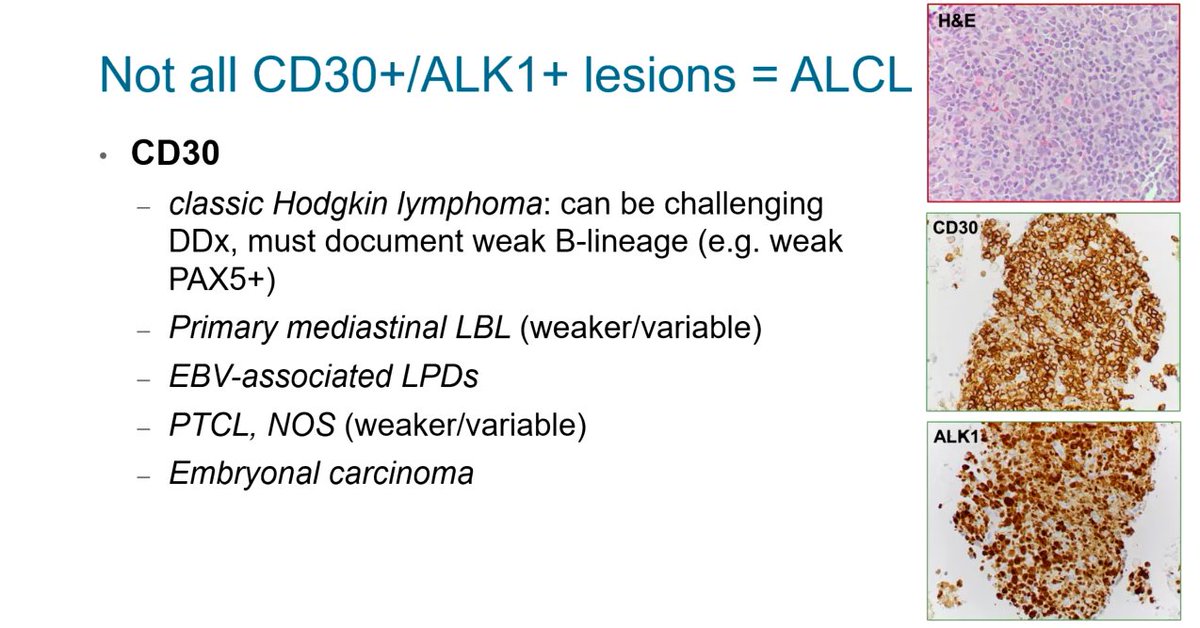 #HemePath
Not all CD30+/ALK1+ lesions are Anaplastic large cell lymphoma (ALCL)

It is possible to see CD30 expression in all of these differential diagnoses (see pic), but it is almost never at this level of intensity.

Dr. Patel #CAP24 #pathology #pathologists #PathTwitter