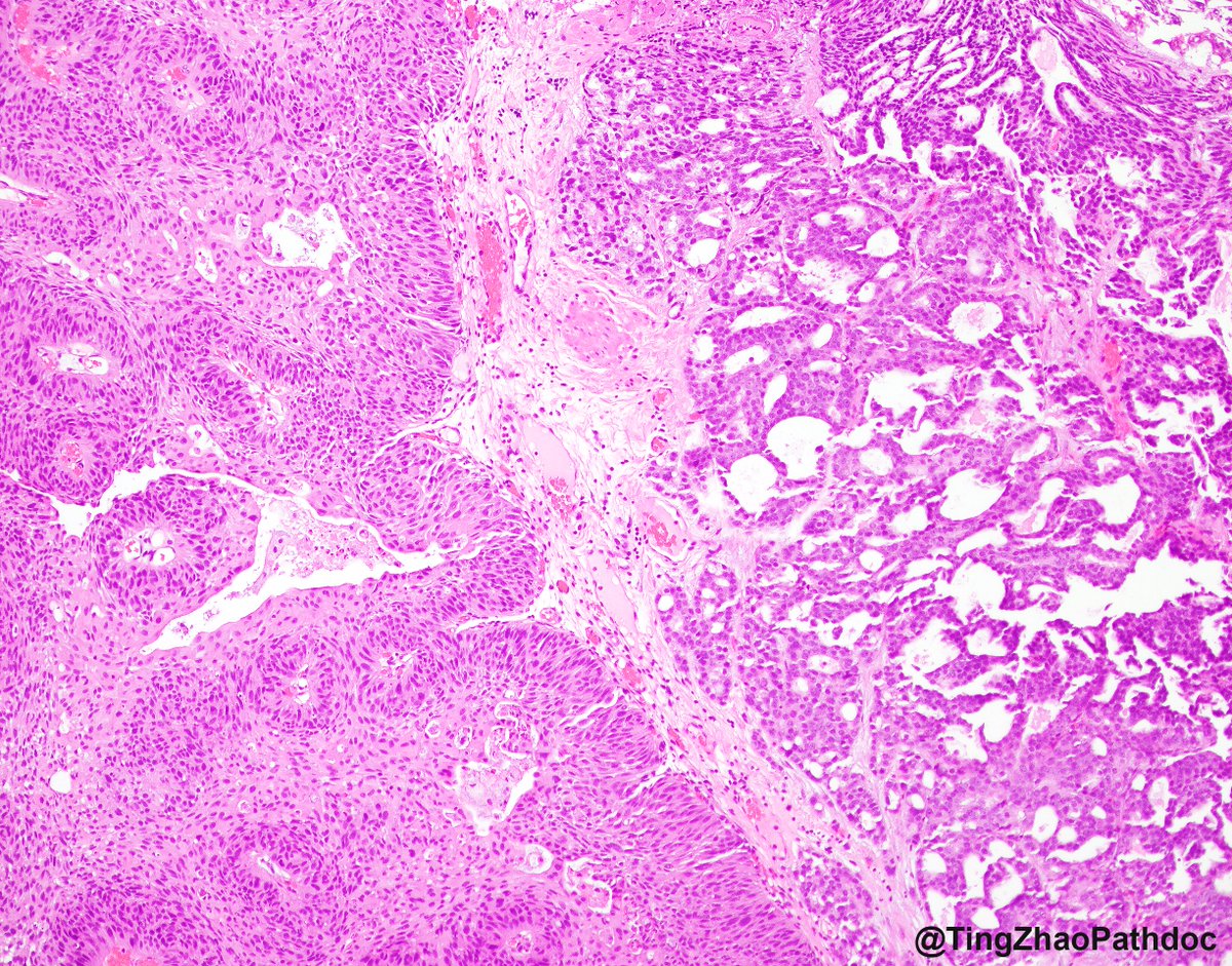 Ting Zhao, MD (@tingzhaopathdoc) on Twitter photo 88 y.o. M, bladder TURBT specimen. What is the diagnosis?
#GUPath <a href="/MGBpathology/">Mass General Brigham Pathology</a> 88 y.o. M, bladder TURBT specimen. What is the diagnosis?
#GUPath <a href="/MGBpathology/">Mass General Brigham Pathology</a>